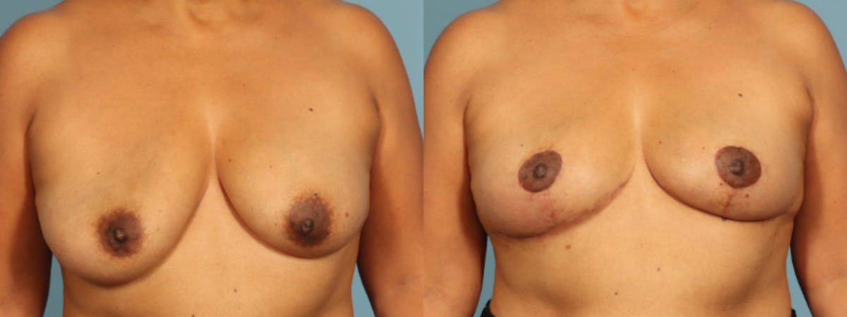 Implant Removal Before & After Gallery - Patient 235622 - Image 1