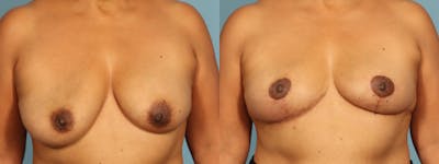 Implant Removal Before & After Gallery - Patient 235622 - Image 1