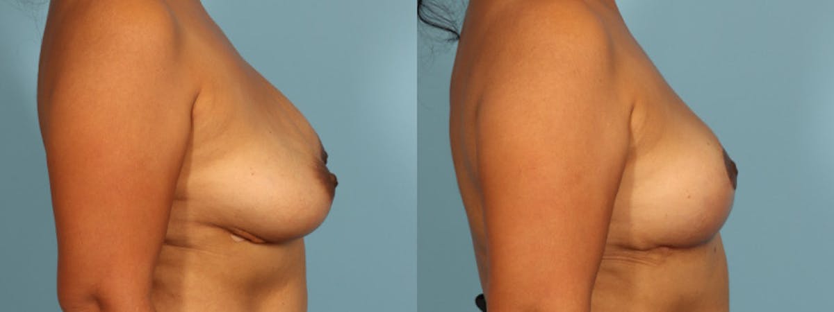 Implant Removal Before & After Gallery - Patient 235622 - Image 2