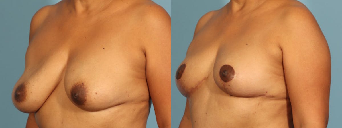 Implant Removal Before & After Gallery - Patient 235622 - Image 3
