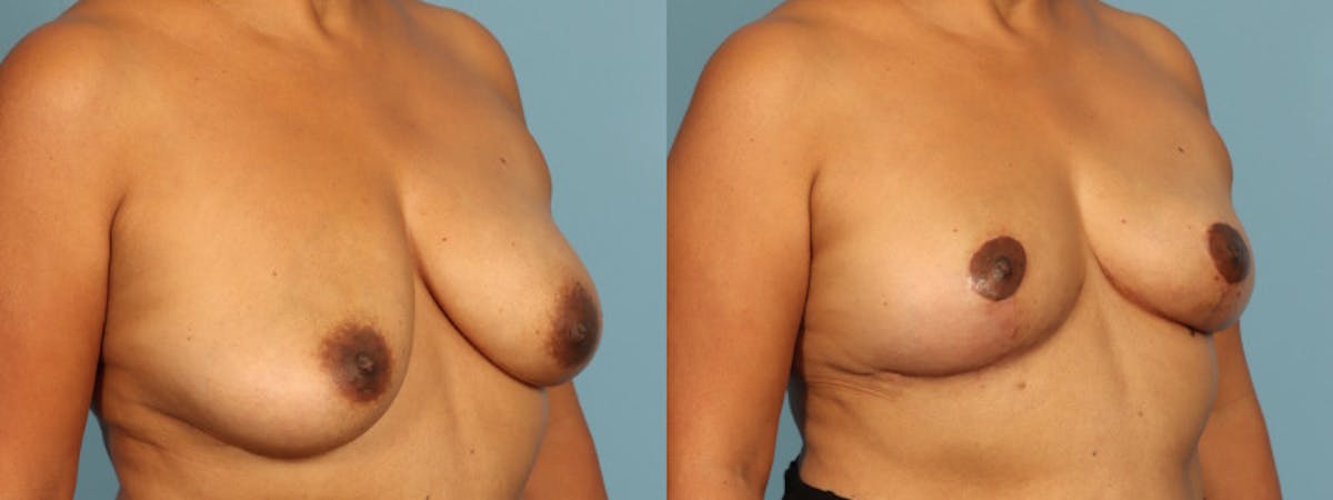 Implant Removal Before & After Gallery - Patient 235622 - Image 4