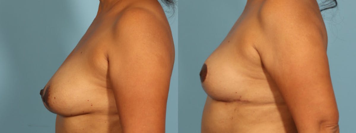 Implant Removal Before & After Gallery - Patient 235622 - Image 5