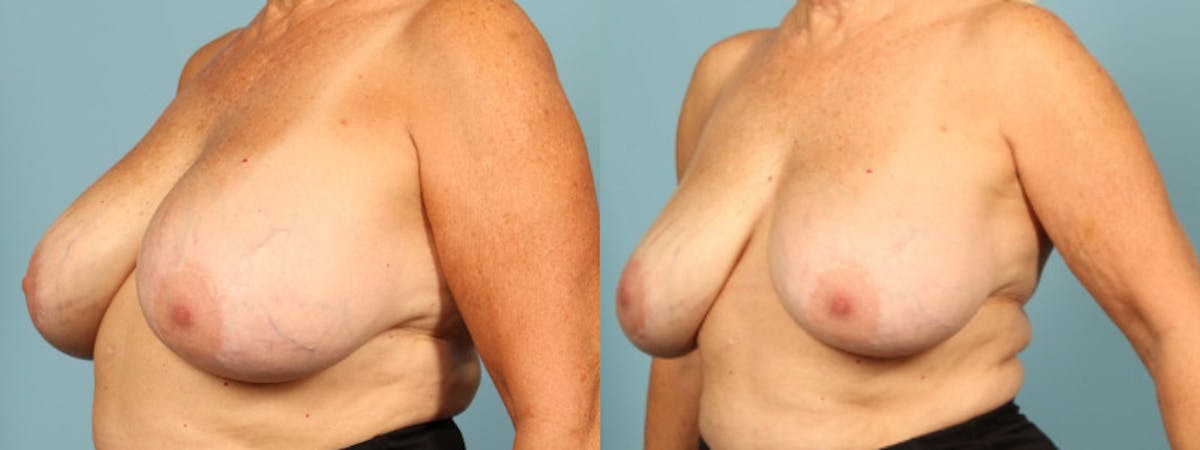 Implant Removal Before & After Gallery - Patient 330438 - Image 1