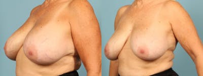 Implant Removal Before & After Gallery - Patient 330438 - Image 1