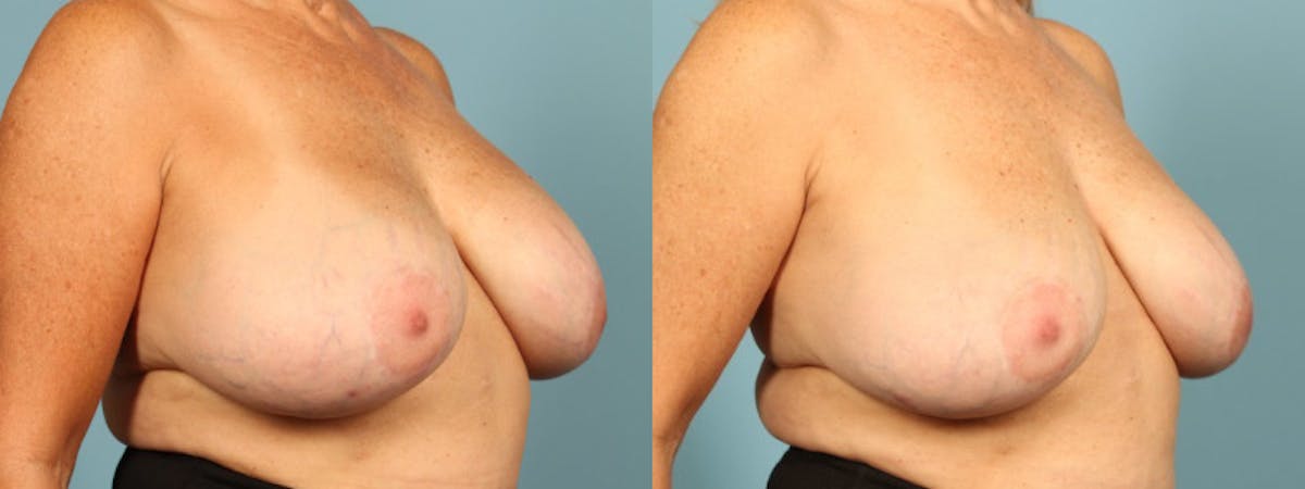 Implant Removal Before & After Gallery - Patient 330438 - Image 2