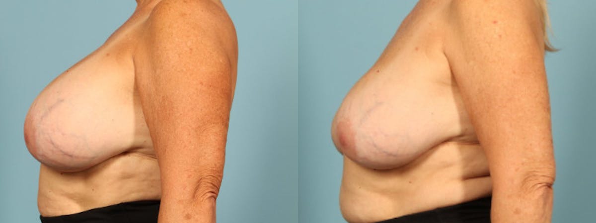 Implant Removal Before & After Gallery - Patient 330438 - Image 3