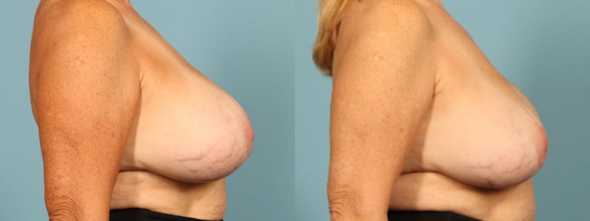 Implant Removal Before & After Gallery - Patient 330438 - Image 4