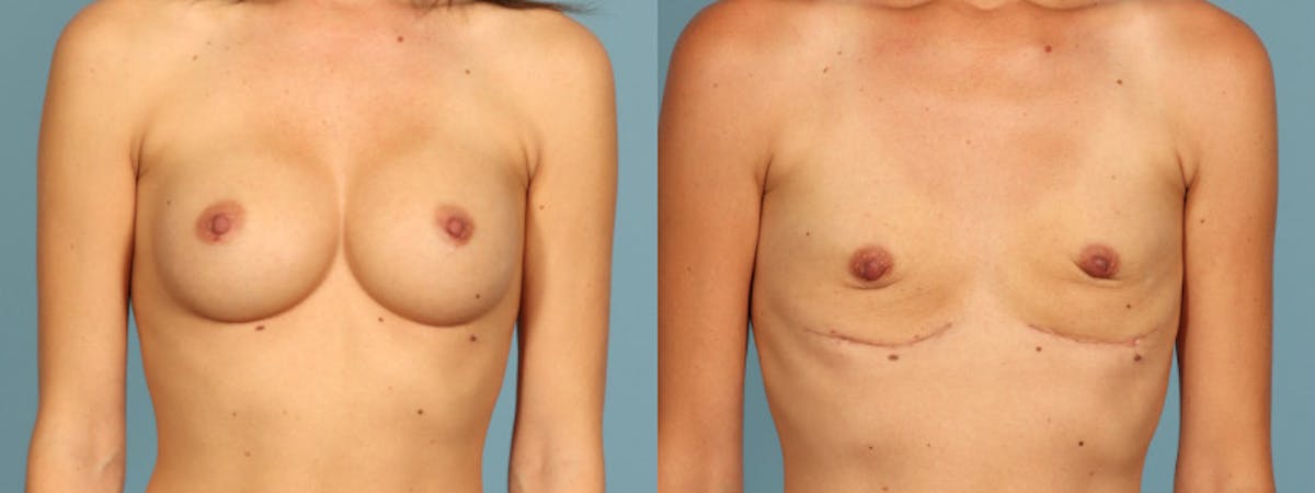 Implant Removal Before & After Gallery - Patient 426242 - Image 1