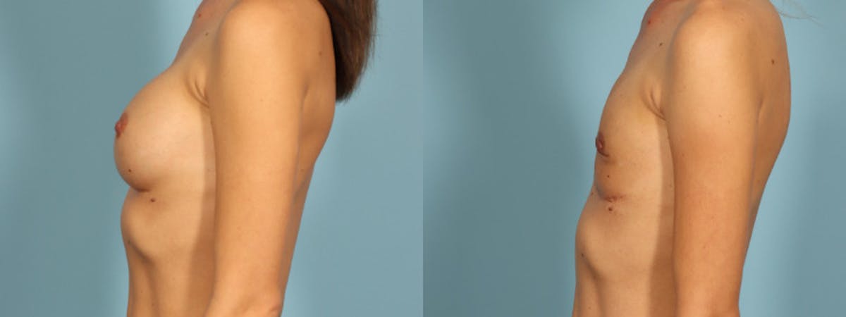 Implant Removal Before & After Gallery - Patient 426242 - Image 2
