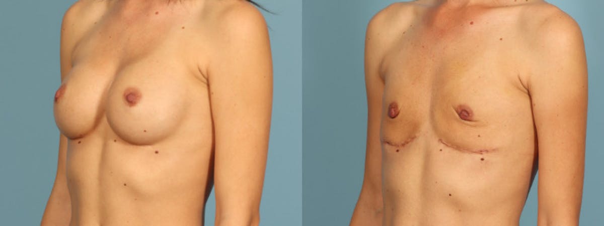 Implant Removal Before & After Gallery - Patient 426242 - Image 4