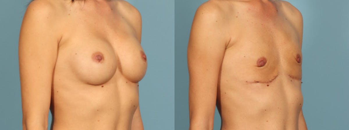 Implant Removal Before & After Gallery - Patient 426242 - Image 5