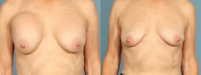 Implant Removal Before & After Gallery - Patient 363587 - Image 1