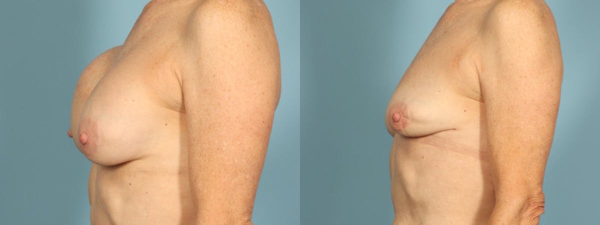 Implant Removal Before & After Gallery - Patient 363587 - Image 2