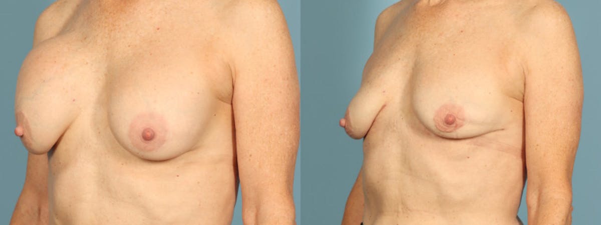 Implant Removal Before & After Gallery - Patient 363587 - Image 3