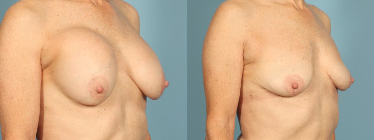 Implant Removal Before & After Gallery - Patient 363587 - Image 4