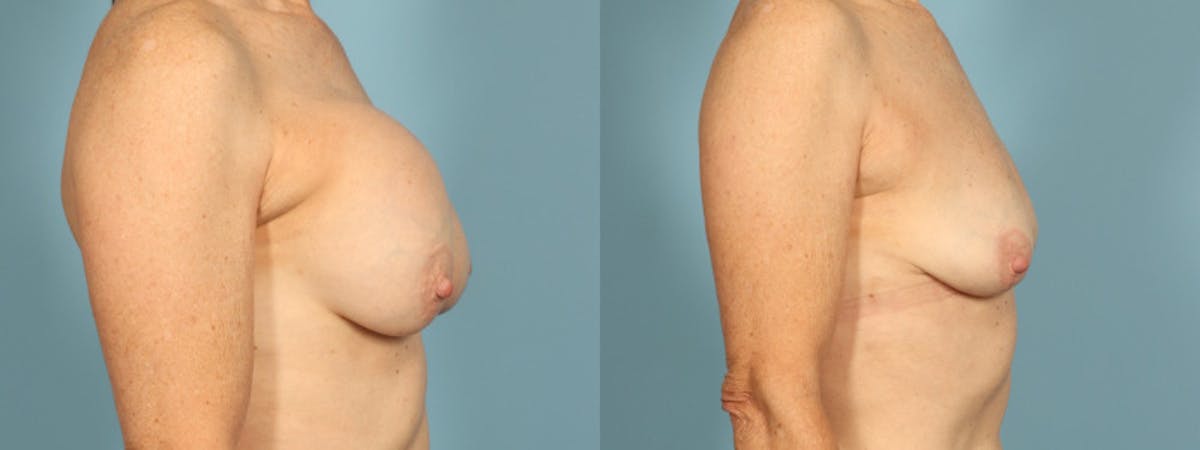 Implant Removal Before & After Gallery - Patient 363587 - Image 5