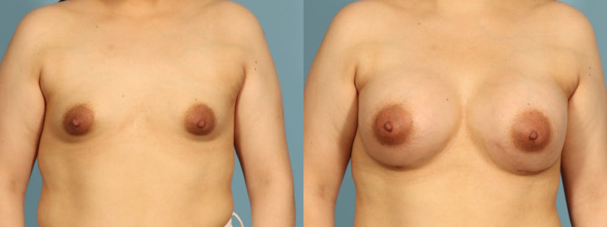 Tuberous Breast Before & After Gallery - Patient 168315 - Image 1