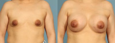 Tuberous Breast Before & After Gallery - Patient 168315 - Image 1