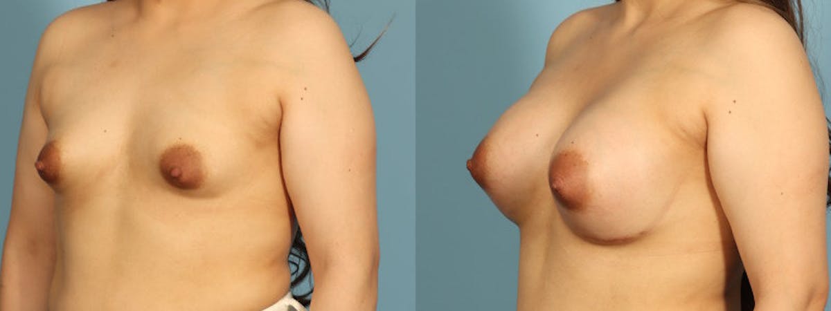 Tuberous Breast Before & After Gallery - Patient 168315 - Image 2
