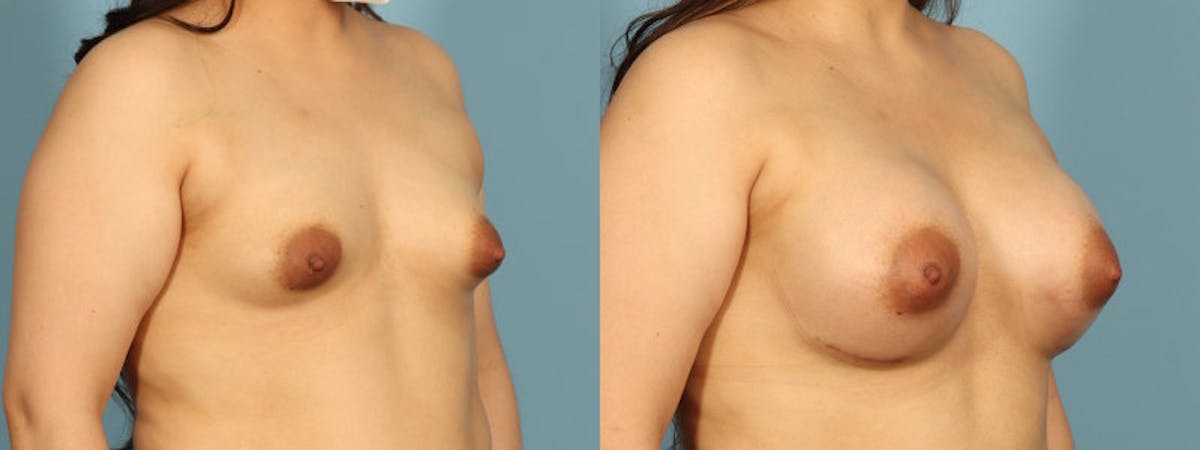 Tuberous Breast Before & After Gallery - Patient 168315 - Image 3