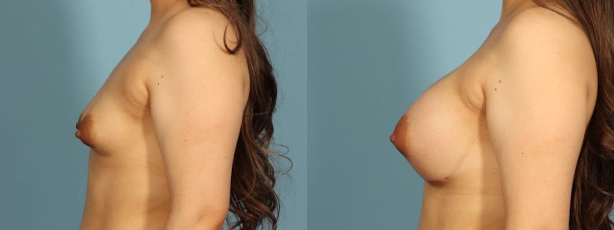 Tuberous Breast Before & After Gallery - Patient 168315 - Image 4
