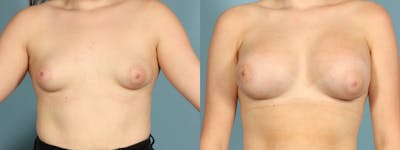 Tuberous Breast Before & After Gallery - Patient 692733 - Image 1