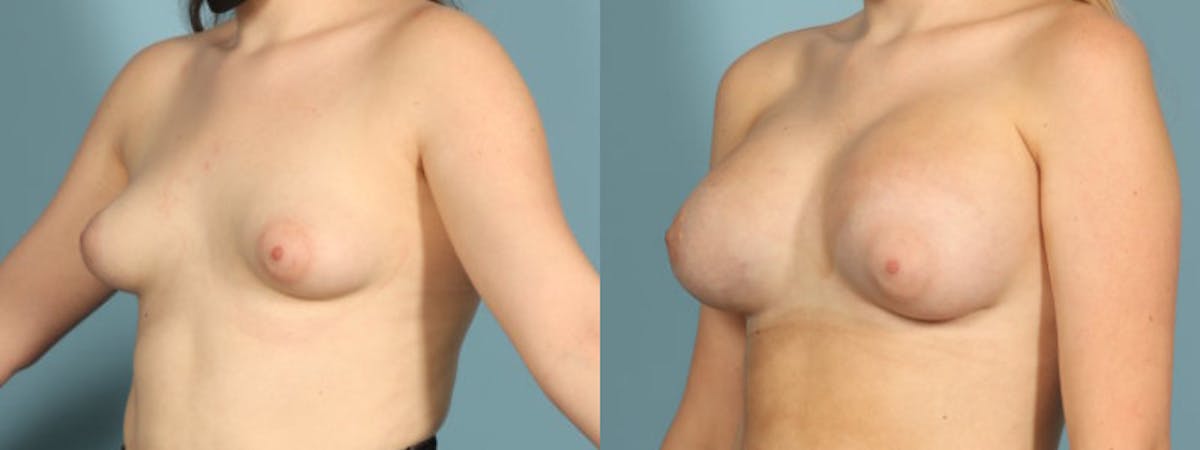 Tuberous Breast Before & After Gallery - Patient 692733 - Image 2