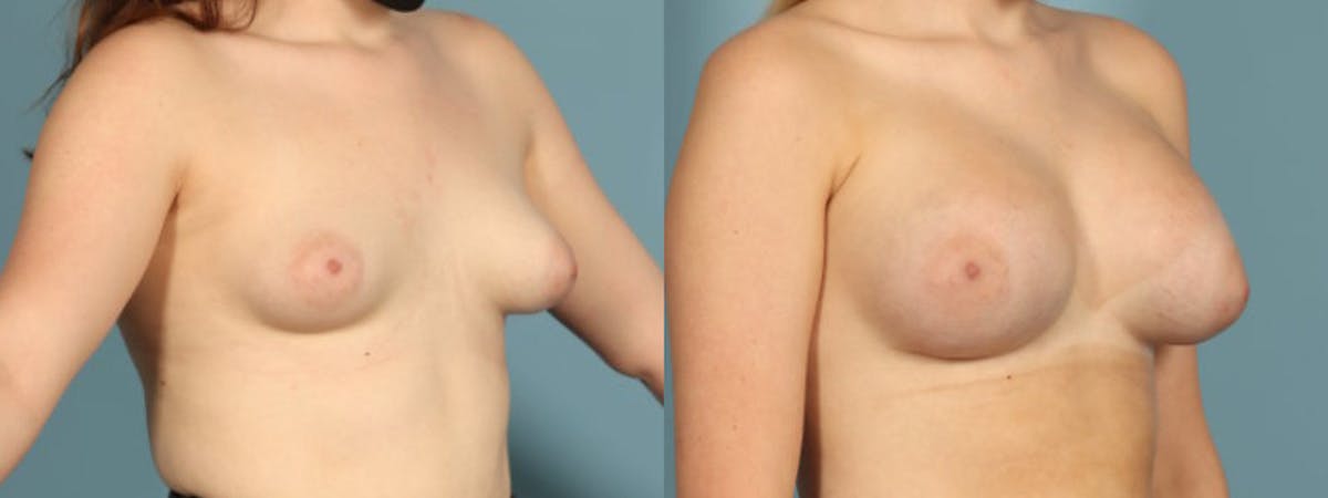 Tuberous Breast Before & After Gallery - Patient 692733 - Image 3