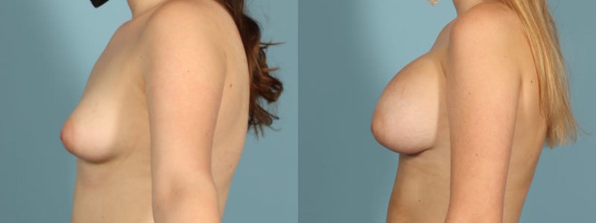 Tuberous Breast Before & After Gallery - Patient 692733 - Image 4