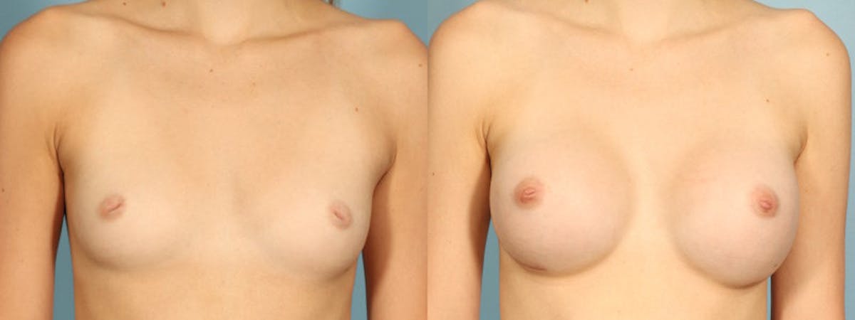 Nipple Surgery Before & After Gallery - Patient 534575 - Image 1