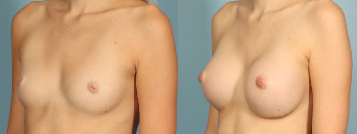 Nipple Surgery Before & After Gallery - Patient 534575 - Image 2