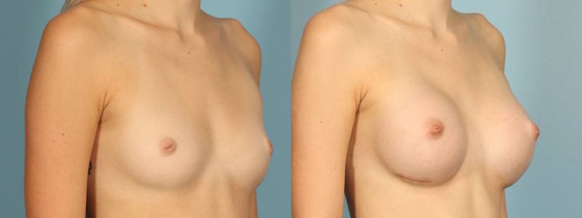 Nipple Surgery Before & After Gallery - Patient 534575 - Image 3