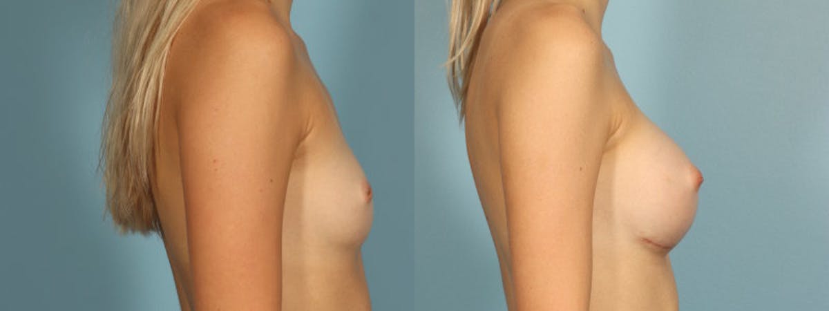 Nipple Surgery Before & After Gallery - Patient 534575 - Image 5