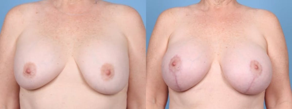 Breast Augmentation w/ Lift Before & After Gallery - Patient 207040 - Image 1