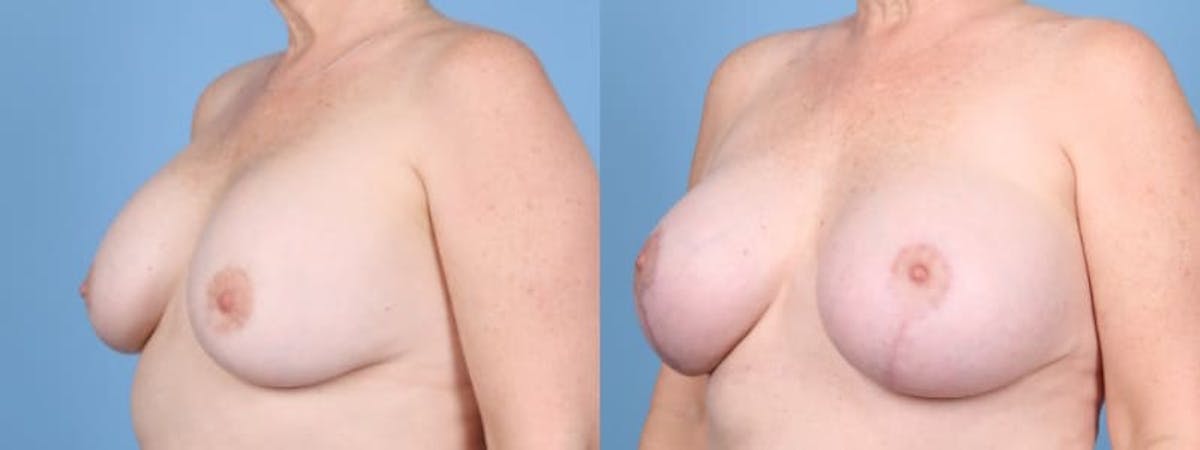 Breast Augmentation w/ Lift Before & After Gallery - Patient 207040 - Image 2