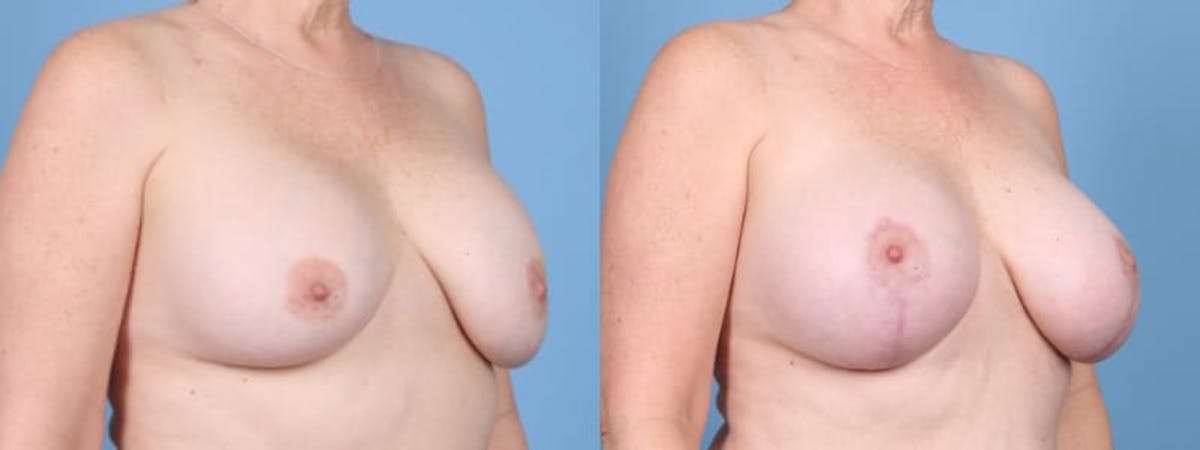 Breast Augmentation w/ Lift Before & After Gallery - Patient 207040 - Image 3