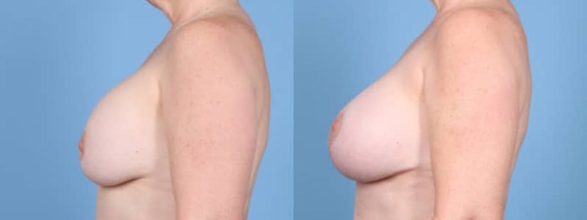 Breast Augmentation w/ Lift Before & After Gallery - Patient 207040 - Image 4