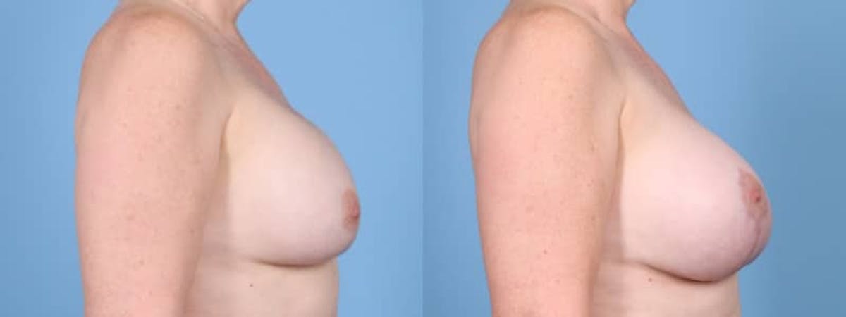 Breast Augmentation w/ Lift Before & After Gallery - Patient 207040 - Image 5