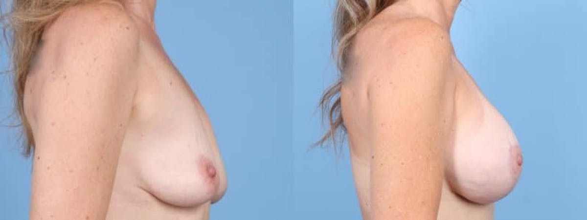 Breast Augmentation w/ Lift Before & After Gallery - Patient 406759 - Image 5