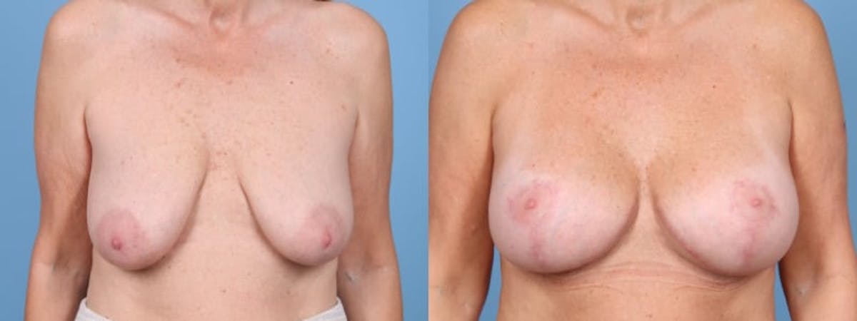 Breast Augmentation w/ Lift Before & After Gallery - Patient 115328 - Image 1