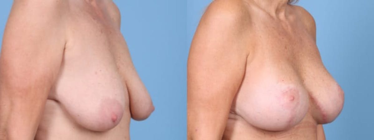 Breast Augmentation w/ Lift Before & After Gallery - Patient 115328 - Image 2
