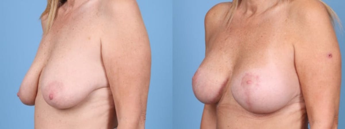 Breast Augmentation w/ Lift Before & After Gallery - Patient 115328 - Image 3