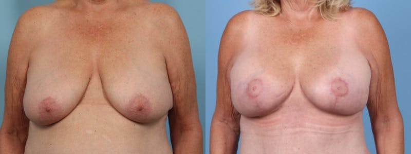 Breast Augmentation w/ Lift Before & After Gallery - Patient 149847 - Image 1