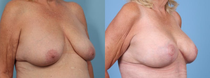 Breast Augmentation w/ Lift Before & After Gallery - Patient 149847 - Image 2