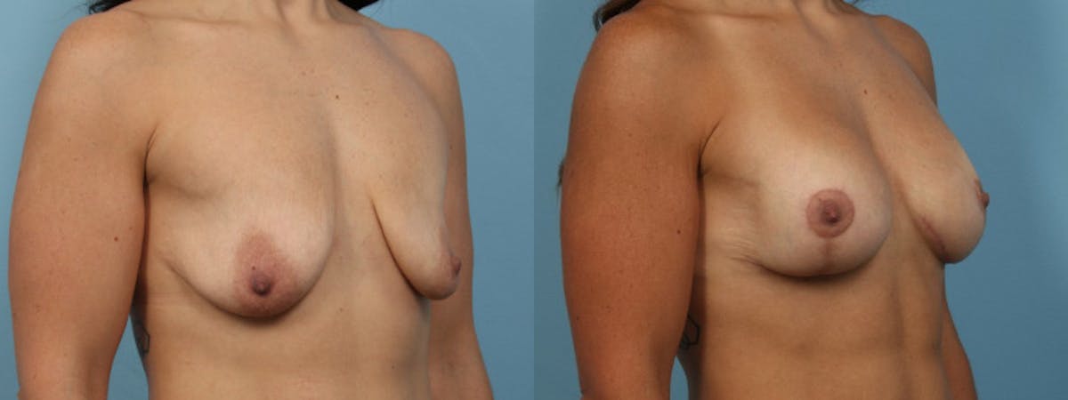 Breast Augmentation w/ Lift Before & After Gallery - Patient 246601 - Image 2