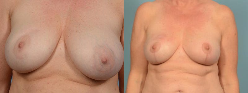 Breast Reduction/Lift Before & After Gallery - Patient 341815 - Image 1