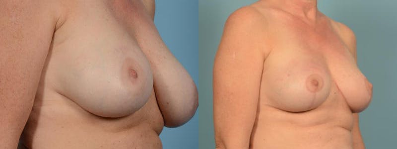 Breast Reduction/Lift Before & After Gallery - Patient 341815 - Image 2