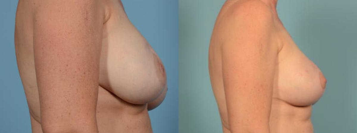 Breast Augmentation w/ Lift Before & After Gallery - Patient 182030 - Image 3