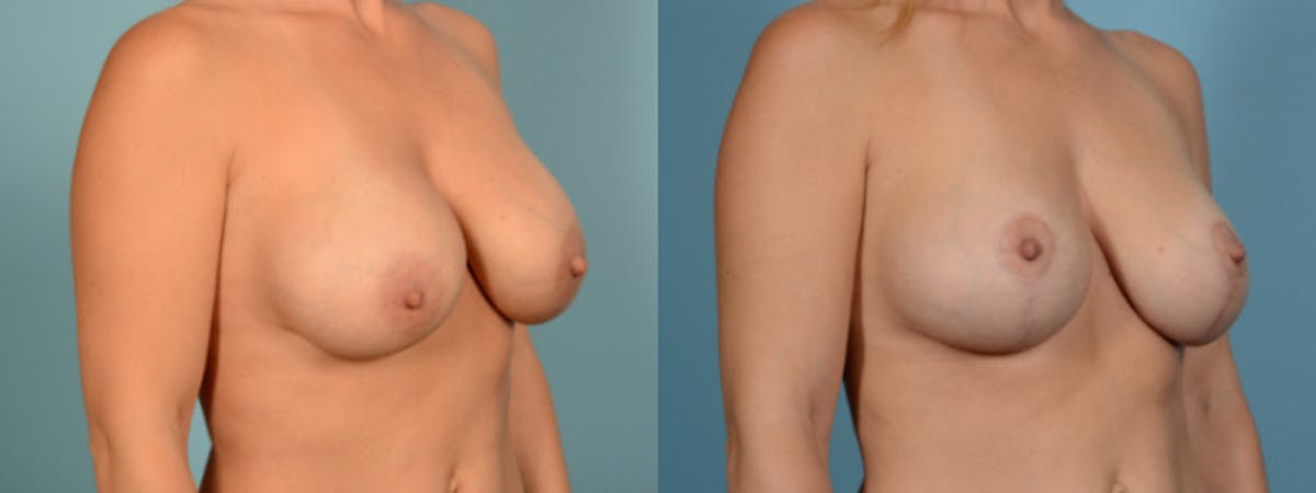 Breast Augmentation w/ Lift Before & After Gallery - Patient 357797 - Image 2
