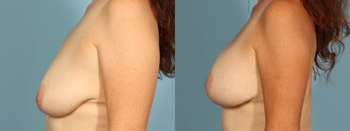 Breast Augmentation w/ Lift Before & After Gallery - Patient 186243 - Image 4